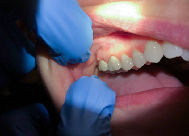 Best Emergency Wisdom Teeth Removal in Foster Brook, PA